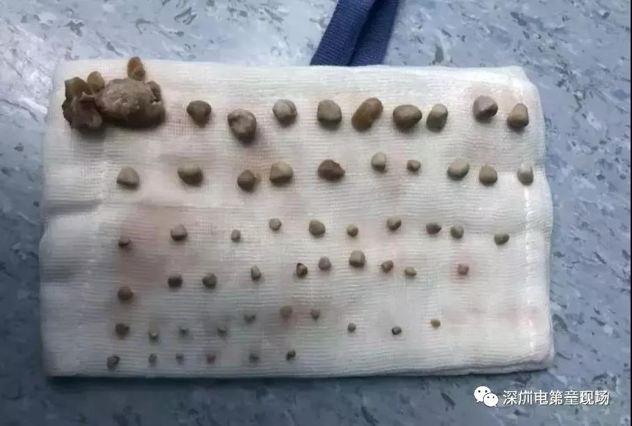9岁娃肾里取出56颗结石！很多小孩都有这样的饮食习惯