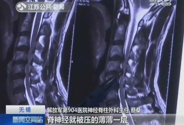 他的脊髓只剩一条线！看完再也不敢歪在沙发上玩手机了