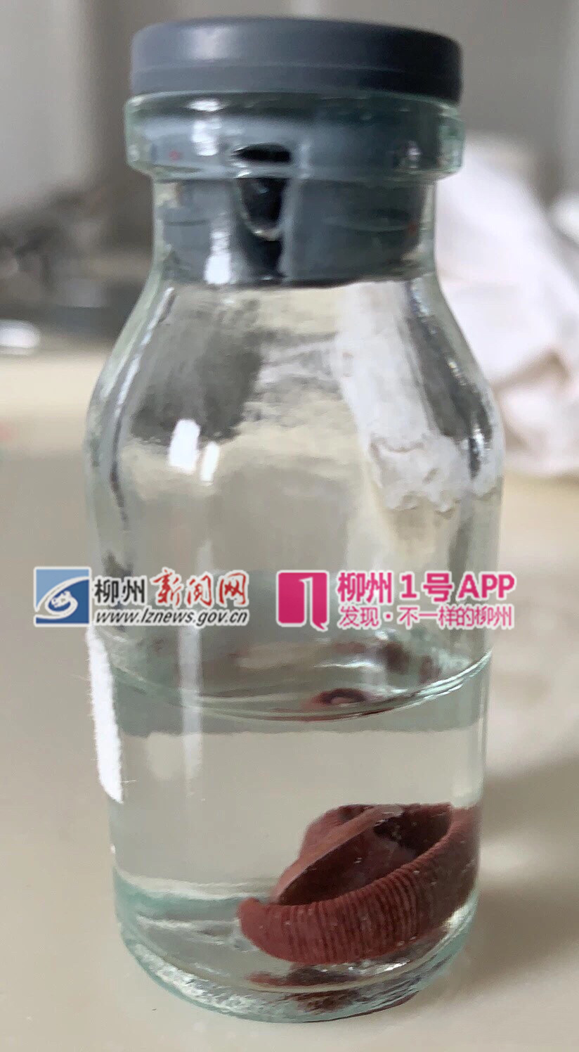 近期高发！柳州23岁小伙鼻腔取出近6厘米长蚂蟥，只因做了此事